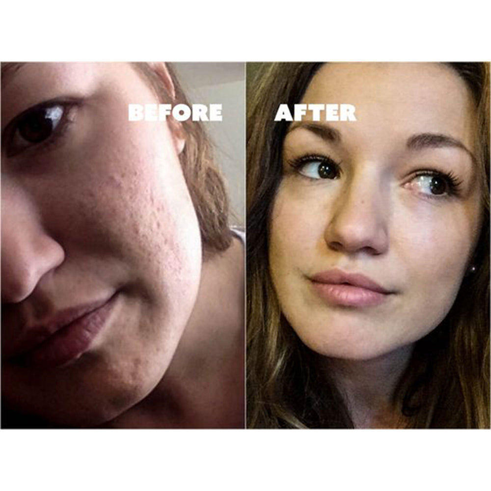 Micro-needle Mezoroller Pen Skincare Tool